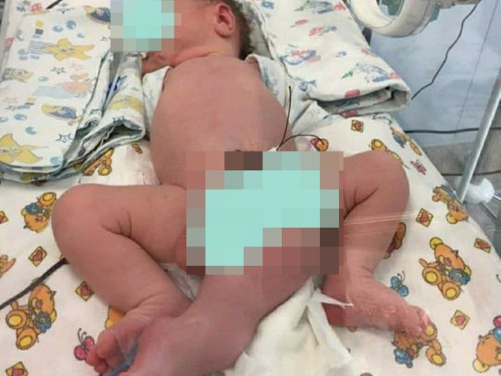 Chłopiec urodził się z trzema nogami, dwoma penisami i bez odbytu